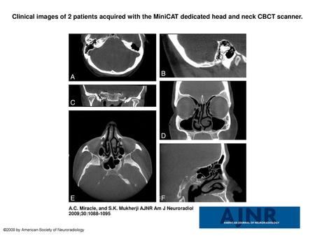 Clinical images of 2 patients acquired with the MiniCAT dedicated head and neck CBCT scanner. Clinical images of 2 patients acquired with the MiniCAT dedicated.