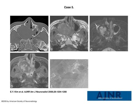 Case 5. Case 5. Organized hematoma of the maxillary sinus in a 50-year-old man. A, Precontrast axial CT scan with bone algorithm shows a large, expansile.