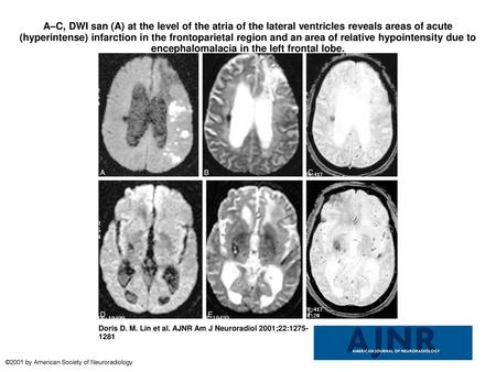 A–C, DWI san (A) at the level of the atria of the lateral ventricles reveals areas of acute (hyperintense) infarction in the frontoparietal region and.