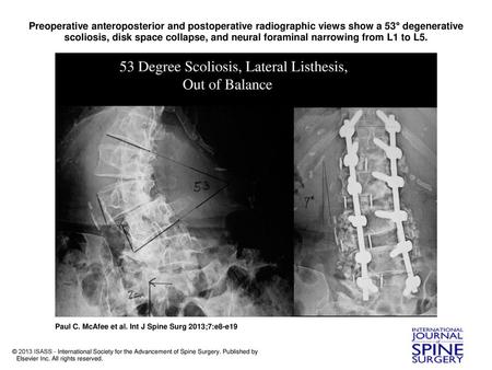 Preoperative anteroposterior and postoperative radiographic views show a 53° degenerative scoliosis, disk space collapse, and neural foraminal narrowing.
