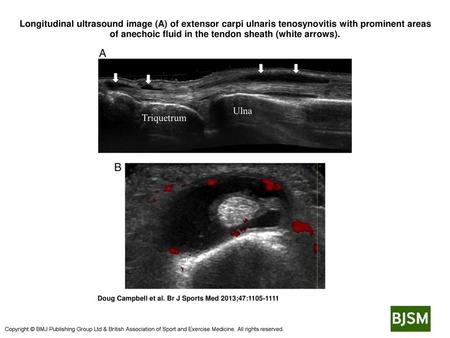 Longitudinal ultrasound image (A) of extensor carpi ulnaris tenosynovitis with prominent areas of anechoic fluid in the tendon sheath (white arrows). Longitudinal.