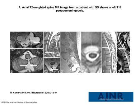 A, Axial T2-weighted spine MR image from a patient with SS shows a left T12 pseudomeningocele. A, Axial T2-weighted spine MR image from a patient with.