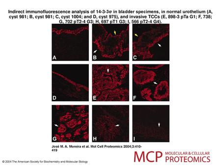 Indirect immunofluorescence analysis of 14-3-3σ in bladder specimens, in normal urothelium (A, cyst 981; B, cyst 981; C, cyst 1004; and D, cyst 975), and.
