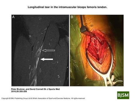 Longitudinal tear in the intramuscular biceps femoris tendon.