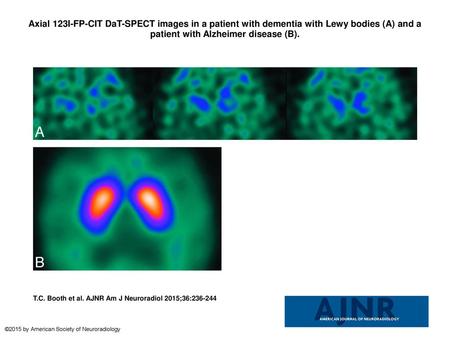 Axial 123I-FP-CIT DaT-SPECT images in a patient with dementia with Lewy bodies (A) and a patient with Alzheimer disease (B). Axial 123I-FP-CIT DaT-SPECT.
