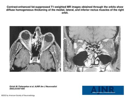 Contrast-enhanced fat-suppressed T1-weighted MR images obtained through the orbits show diffuse homogeneous thickening of the medial, lateral, and inferior.