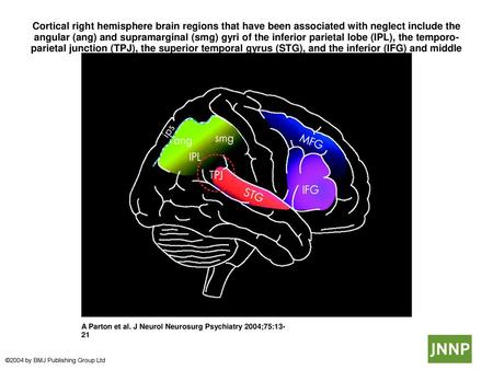 Cortical right hemisphere brain regions that have been associated with neglect include the angular (ang) and supramarginal (smg) gyri of the inferior parietal.