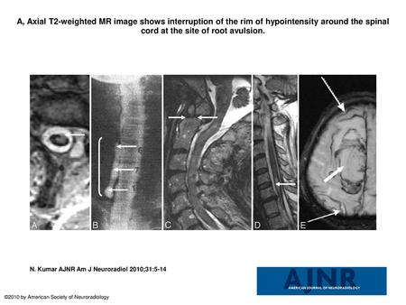 A, Axial T2-weighted MR image shows interruption of the rim of hypointensity around the spinal cord at the site of root avulsion. A, Axial T2-weighted.