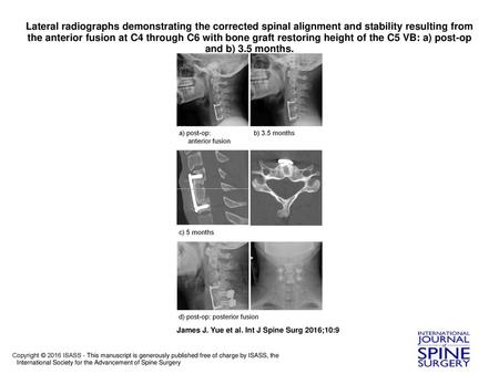 Lateral radiographs demonstrating the corrected spinal alignment and stability resulting from the anterior fusion at C4 through C6 with bone graft restoring.