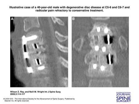 Illustrative case of a 40-year-old male with degenerative disc disease at C5-6 and C6-7 and radicular pain refractory to conservative treatment. Illustrative.