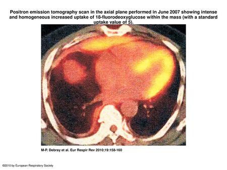Positron emission tomography scan in the axial plane performed in June 2007 showing intense and homogeneous increased uptake of 18-fluorodeoxyglucose within.