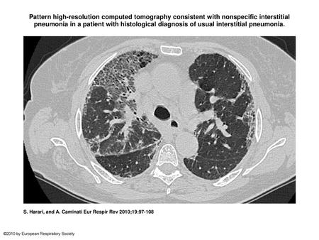 Pattern high-resolution computed tomography consistent with nonspecific interstitial pneumonia in a patient with histological diagnosis of usual interstitial.
