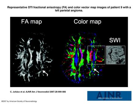 Representative DTI fractional anisotropy (FA) and color vector map images of patient 9 with a left parietal angioma. Representative DTI fractional anisotropy.