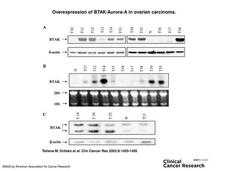 Overexpression of BTAK/Aurora-A in ovarian carcinoma.