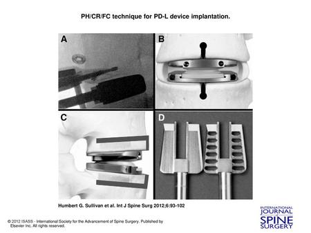 PH/CR/FC technique for PD-L device implantation.