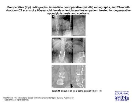 Preoperative (top) radiographs, immediate postoperative (middle) radiographs, and 24-month (bottom) CT scans of a 68-year-old female anteriolateral fusion.