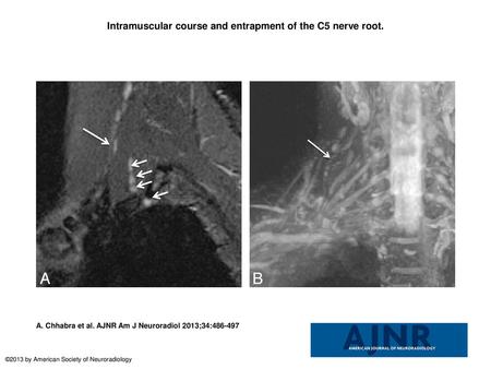 Intramuscular course and entrapment of the C5 nerve root.