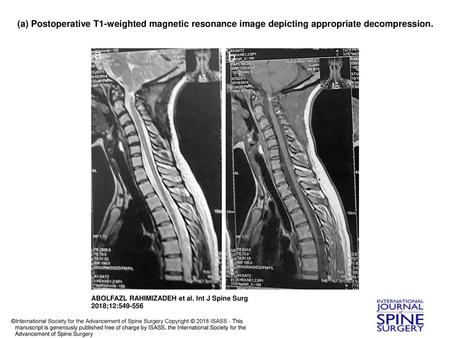 (a) Postoperative T1-weighted magnetic resonance image depicting appropriate decompression. (a) Postoperative T1-weighted magnetic resonance image depicting.