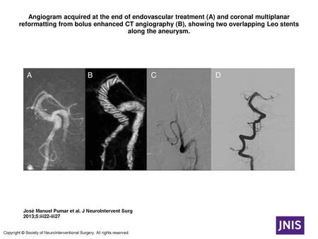Angiogram acquired at the end of endovascular treatment (A) and coronal multiplanar reformatting from bolus enhanced CT angiography (B), showing two overlapping.