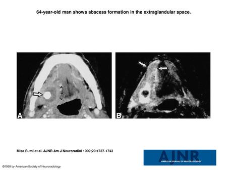 64-year-old man shows abscess formation in the extraglandular space.