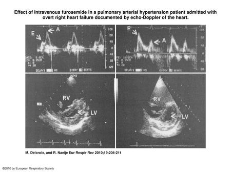 Effect of intravenous furosemide in a pulmonary arterial hypertension patient admitted with overt right heart failure documented by echo-Doppler of the.
