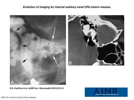 Evolution of imaging for internal auditory canal CPA cistern masses.