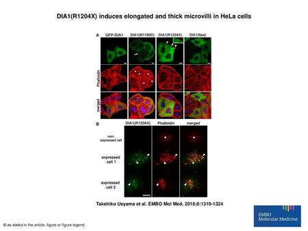 DIA1(R1204X) induces elongated and thick microvilli in HeLa cells