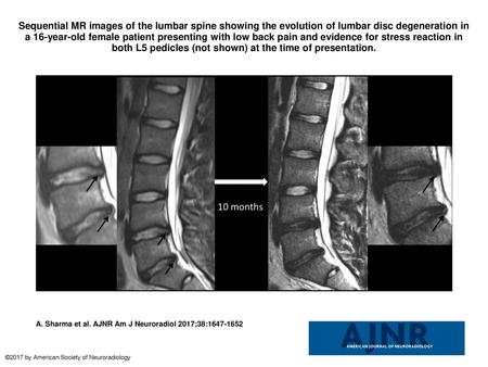 Sequential MR images of the lumbar spine showing the evolution of lumbar disc degeneration in a 16-year-old female patient presenting with low back pain.