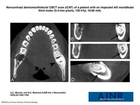 Noncontrast dentomaxillofacial CBCT scan (iCAT) of a patient with an impacted left mandibular third molar (0.4-mm pixels, 120 kVp, 18.66 mA). Noncontrast.