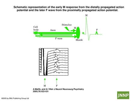  Schematic representation of the early M response from the distally propagated action potential and the later F wave from the proximally propagated action.
