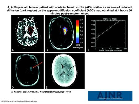 A, A 50-year old female patient with acute ischemic stroke (AIS), visible as an area of reduced diffusion (dark region) on the apparent diffusion coefficient.