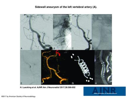 Sidewall aneurysm of the left vertebral artery (A).