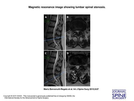 Magnetic resonance image showing lumbar spinal stenosis.