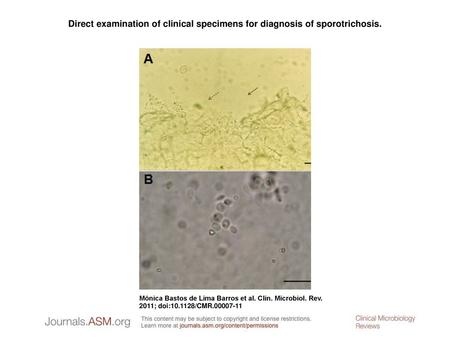 Direct examination of clinical specimens for diagnosis of sporotrichosis. Direct examination of clinical specimens for diagnosis of sporotrichosis. (A)
