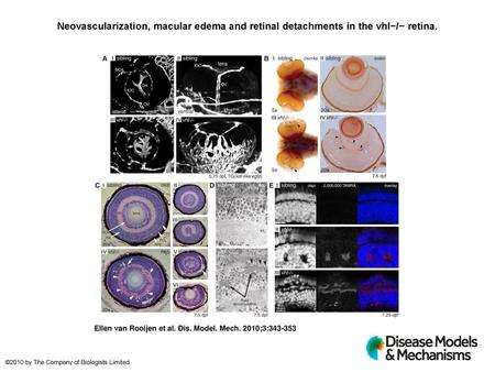 Neovascularization, macular edema and retinal detachments in the vhl−/− retina. Neovascularization, macular edema and retinal detachments in thevhl−/−retina.