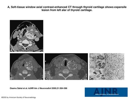A, Soft-tissue window axial contrast-enhanced CT through thyroid cartilage shows expansile lesion from left alar of thyroid cartilage. A, Soft-tissue window.