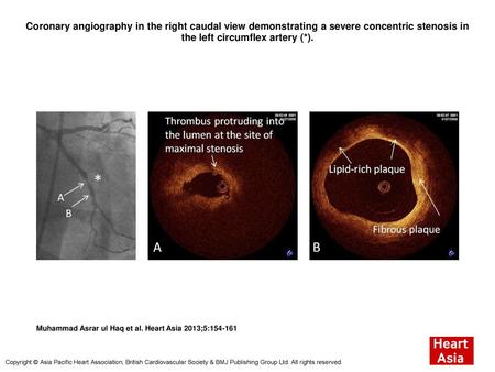 Coronary angiography in the right caudal view demonstrating a severe concentric stenosis in the left circumflex artery (*). Coronary angiography in the.