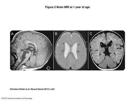 Figure 2 Brain MRI at 1 year of age