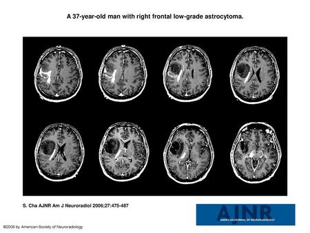 A 37-year-old man with right frontal low-grade astrocytoma.