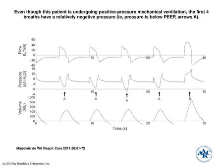 Even though this patient is undergoing positive-pressure mechanical ventilation, the first 4 breaths have a relatively negative pressure (ie, pressure.