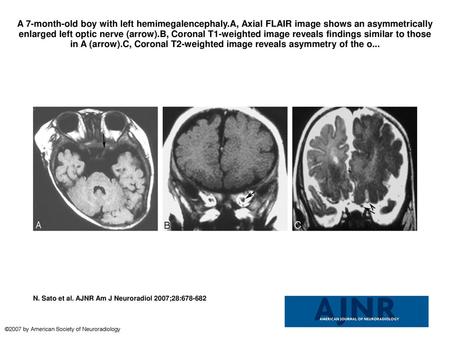 A 7-month-old boy with left hemimegalencephaly