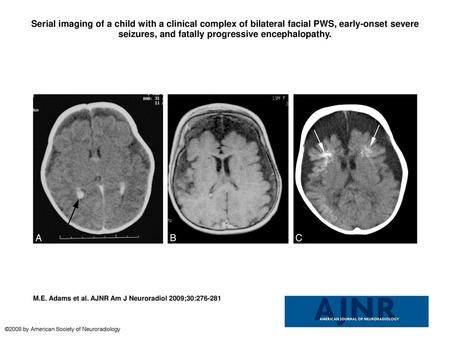 Serial imaging of a child with a clinical complex of bilateral facial PWS, early-onset severe seizures, and fatally progressive encephalopathy. Serial.