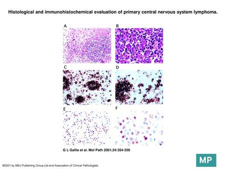 Histological and immunohistochemical evaluation of primary central nervous system lymphoma. Histological and immunohistochemical evaluation of primary.