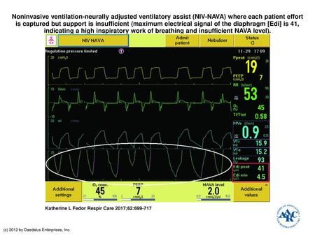 Noninvasive ventilation-neurally adjusted ventilatory assist (NIV-NAVA) where each patient effort is captured but support is insufficient (maximum electrical.