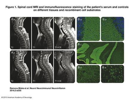Figure 1. Spinal cord MRI and immunofluorescence staining of the patient's serum and controls on different tissues and recombinant cell substrates Spinal.