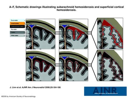 A–F, Schematic drawings illustrating subarachnoid hemosiderosis and superficial cortical hemosiderosis. A–F, Schematic drawings illustrating subarachnoid.