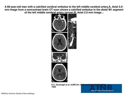 A 66-year-old man with a calcified cerebral embolus to the left middle cerebral artery.A, Axial 2.5-mm image from a noncontrast brain CT scan shows a calcified.