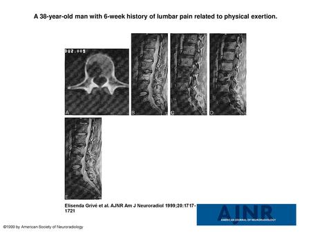 A 38-year-old man with 6-week history of lumbar pain related to physical exertion. A 38-year-old man with 6-week history of lumbar pain related to physical.