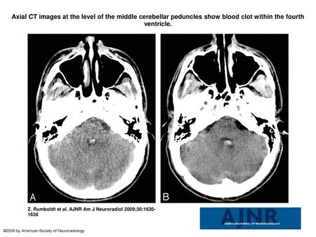 Axial CT images at the level of the middle cerebellar peduncles show blood clot within the fourth ventricle. Axial CT images at the level of the middle.