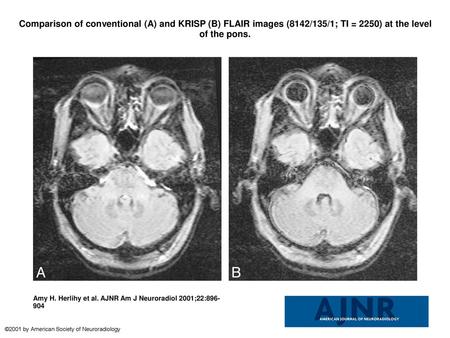 Comparison of conventional (A) and KRISP (B) FLAIR images (8142/135/1; TI = 2250) at the level of the pons. Comparison of conventional (A) and KRISP (B)
